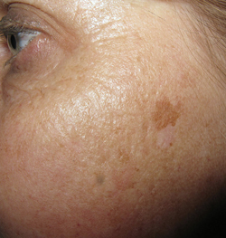 Age Spots, Sun Spots & Liver Spots - DermaNetwork.org