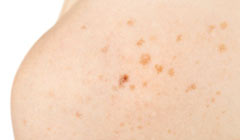 Face-Age-Spots