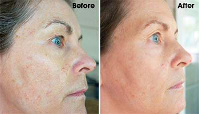 Trophy Skin Pore Infusion Tip - Trophy Skin Microdermabrasion